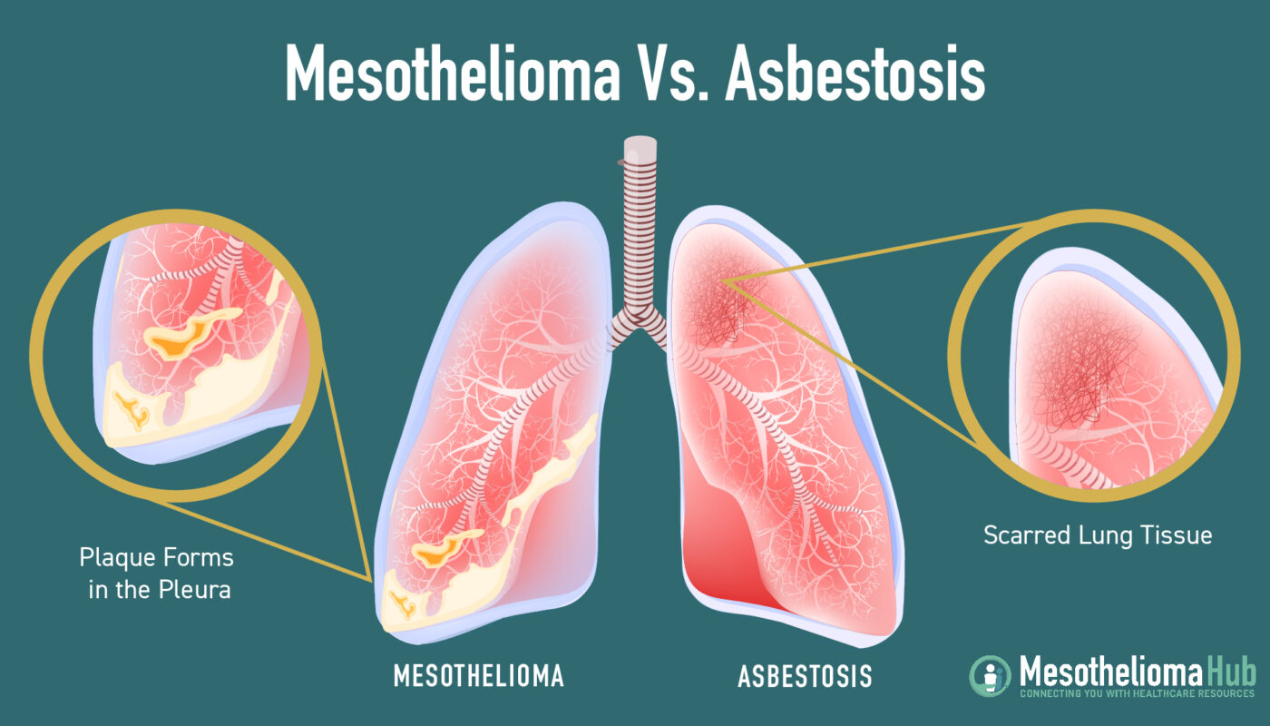 Mesothelioma and Asbestos: What You Need to Know in 2025