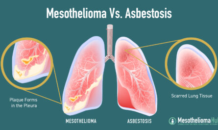 Mesothelioma and Asbestos: What You Need to Know in 2025